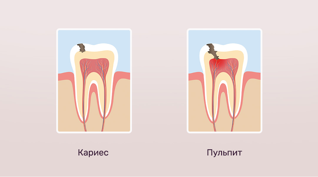 Изображение кариеса и пульпита