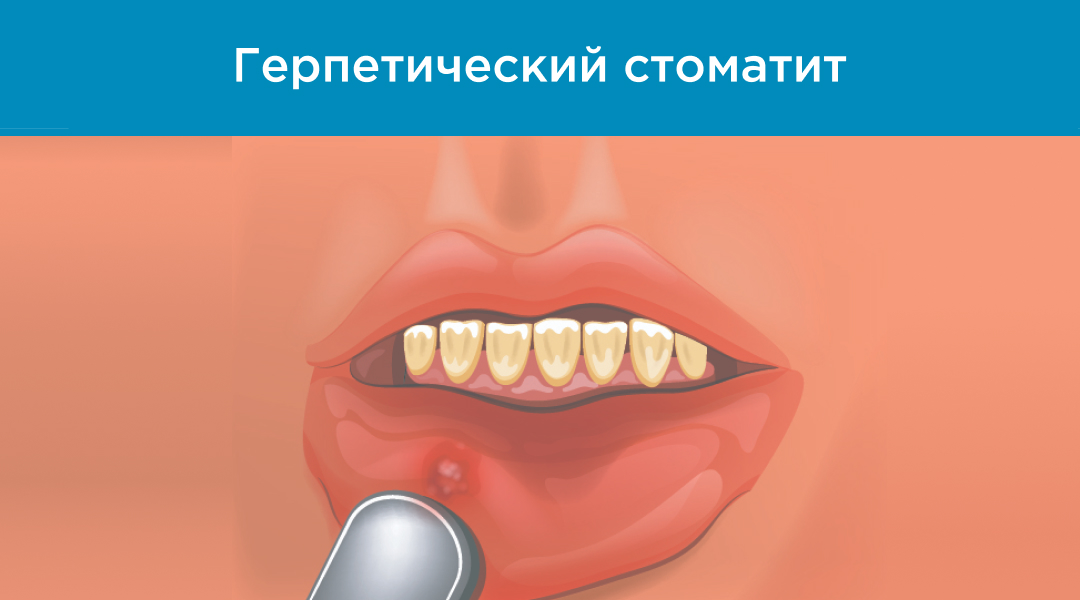 Изображение герпетического стоматита