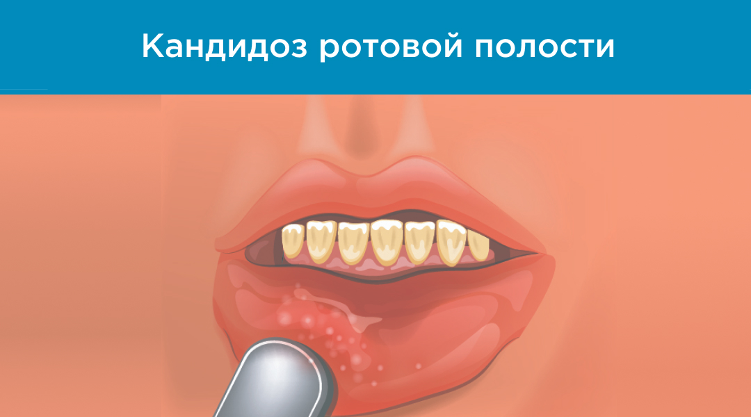 Изображение кандидозного стоматита