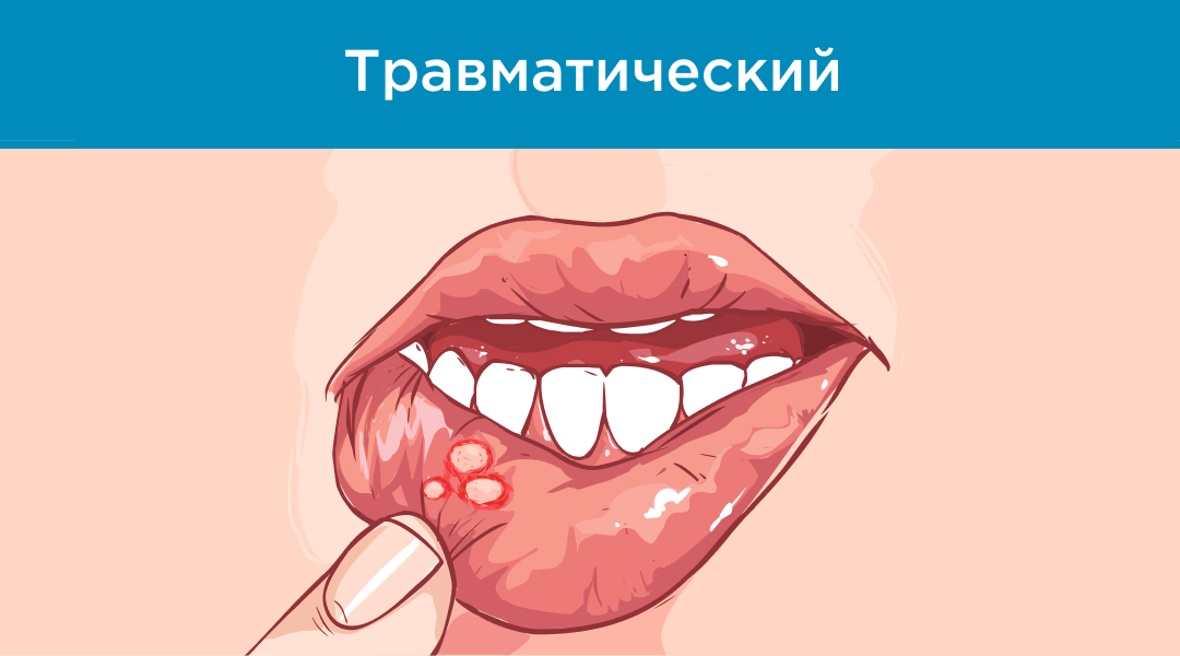 Изображение травматического стоматита